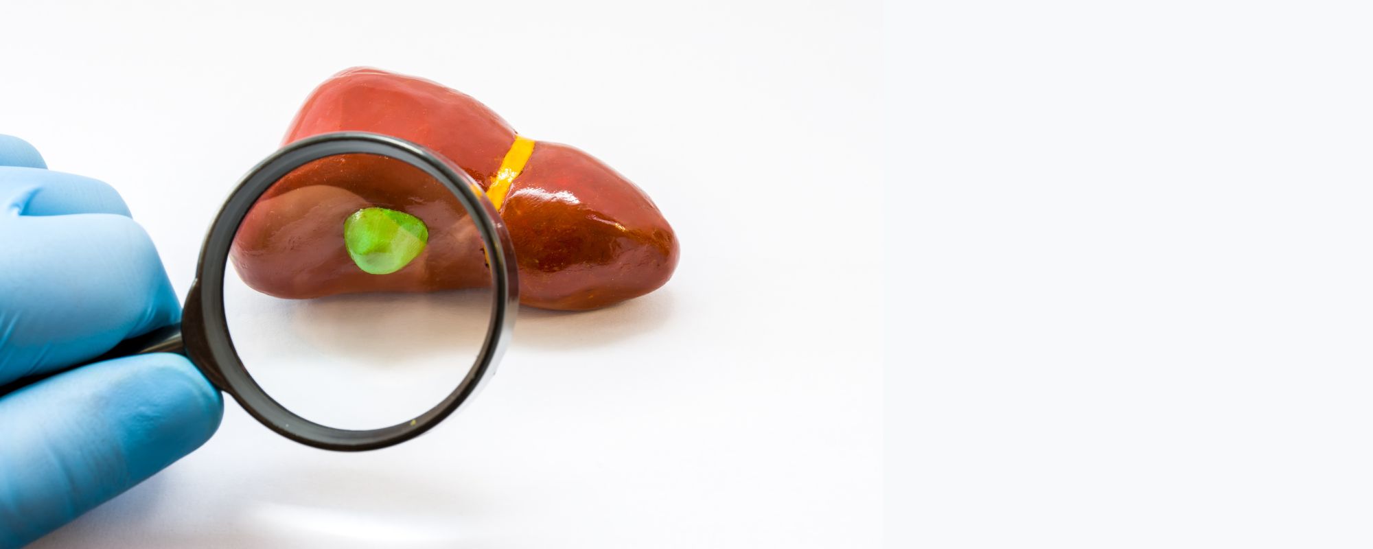 que pasa si se tienen piedras en la vesícula