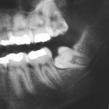 terceros molares